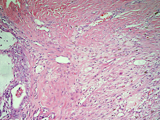Histopathological sections of lung showing extensive tissue reaction along with inflammatory cells infiltrate around the necrotic areas